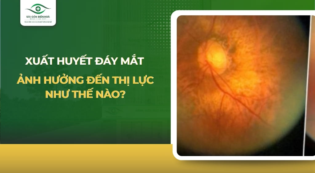 xuất huyết đáy mắt