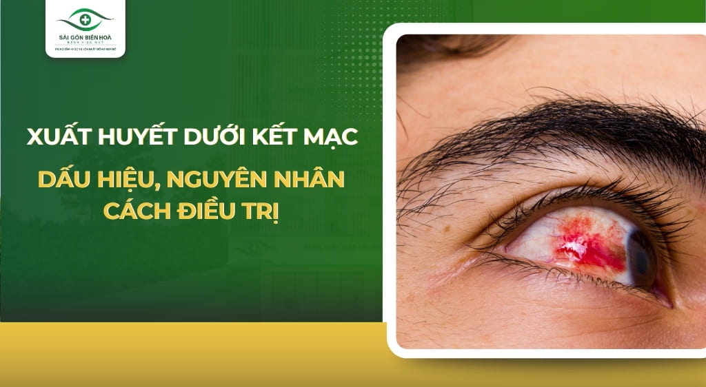 xuất huyết dưới kết mạc