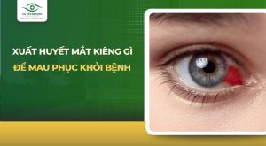 xuất huyết mắt kiêng gì
