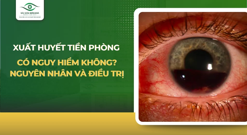 xuất huyết tiền phòng