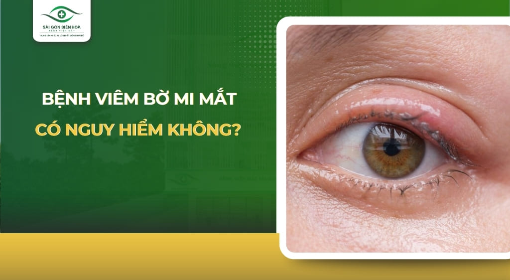 bệnh viêm bờ mi mắt có nguy hiểm không