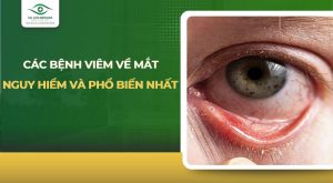 các bệnh viêm về mắt