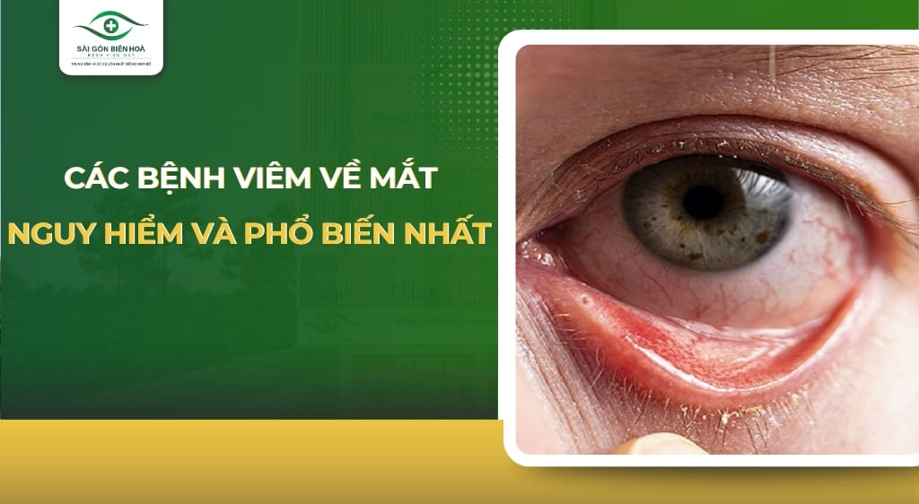 các bệnh viêm về mắt