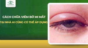 cách chữa viêm bờ mi mắt tại nhà