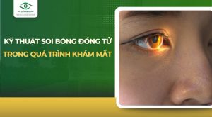 soi bóng đồng tử