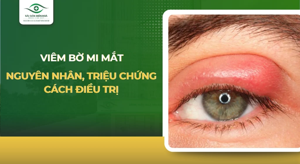viêm bờ mi mắt