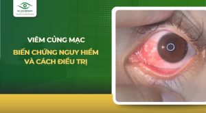 viêm củng mạc