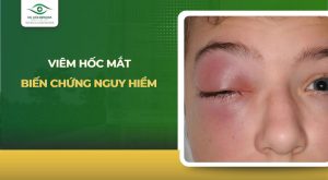 viêm hốc mắt