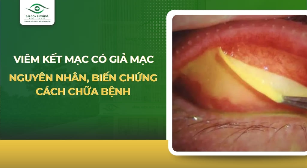 viêm kết mạc có giả mạc