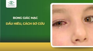 bong giác mạc