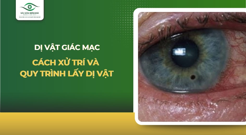 dị vật giác mạc