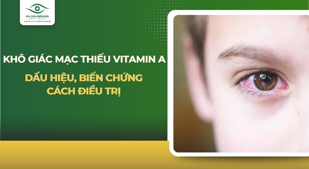 Khô giác mạc thiếu Vitamin A