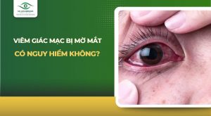 viêm giác mạc bị mờ mắt