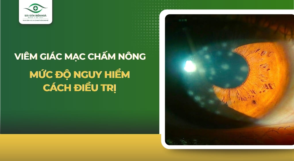 viêm giác mạc chấm nông