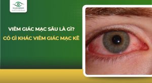 viêm giác mạc sâu