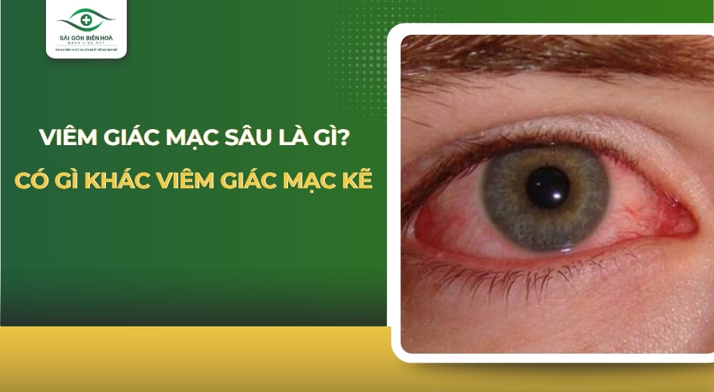 viêm giác mạc sâu