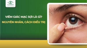 viêm giác mạc sợi