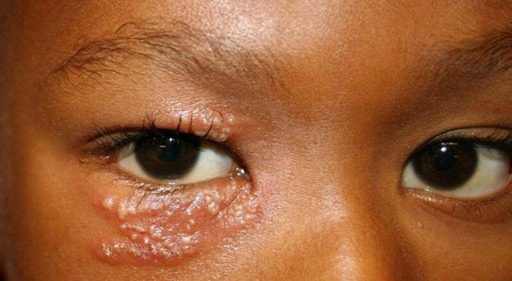 Bệnh zona ở mắt có thể lây lan nếu tiếp xúc trực tiếp với dịch từ mụn nước