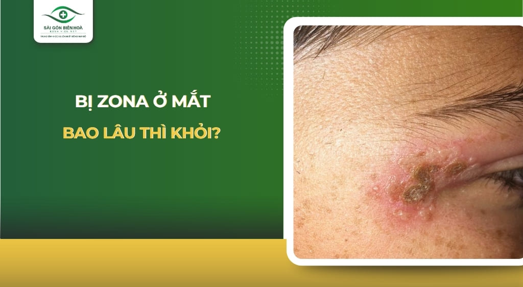 Bị zona ở mắt bao lâu thì khỏi