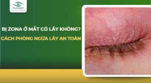 Bị zona ở mắt có lây không