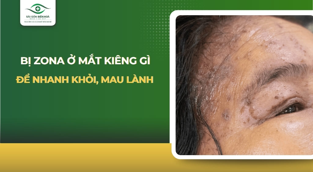 bị zona ở mắt kiêng gì