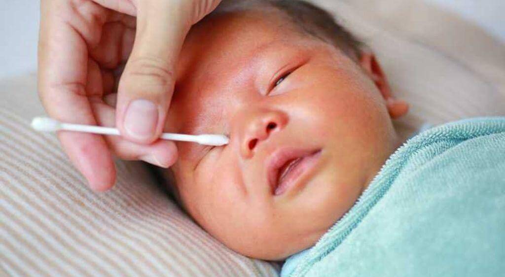 Bôi thuốc cho trẻ bị zona ở mắt theo chỉ định của bác sĩ để đảm bảo an toàn