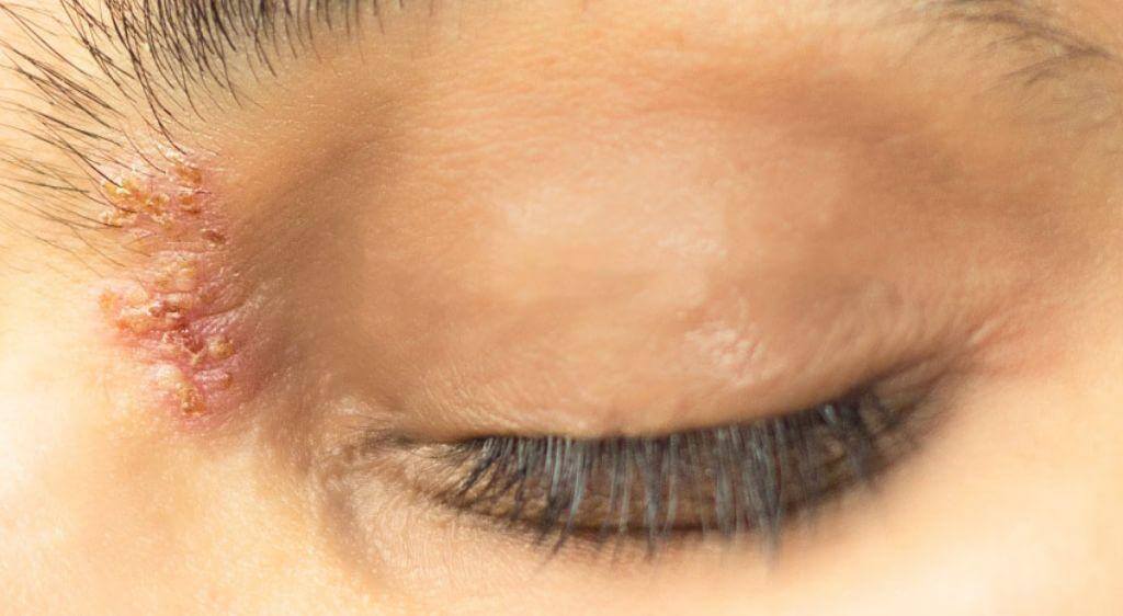 Các nốt mụn nước đã khô, đóng vảy hoàn toàn không có khả năng lây lan