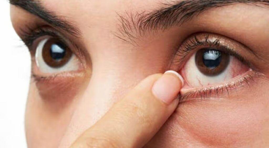 Chi phí lấy sạn vôi ở mắt phụ thuộc vào tình trạng nốt sạn