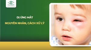 dị ứng mắt