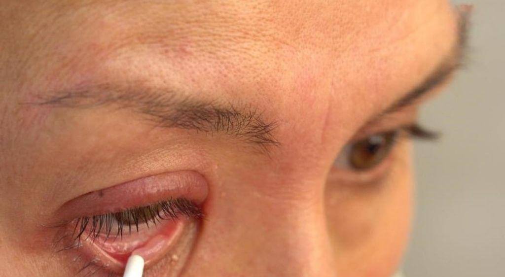 Dùng tăm bông sạch để lấy thuốc và chấm nhẹ lên từng nốt mụn vùng mắt