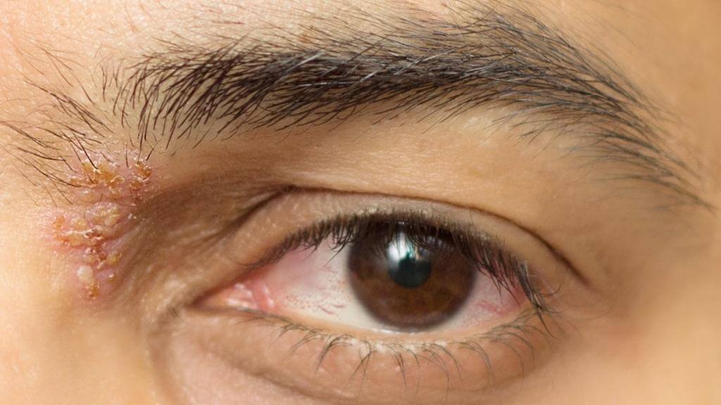 Giời leo ở mắt thường tiến triển nhanh, khiến mắt bị ngứa và rát