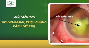 loét giác mạc