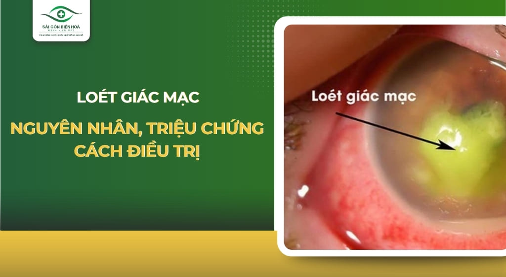 loét giác mạc