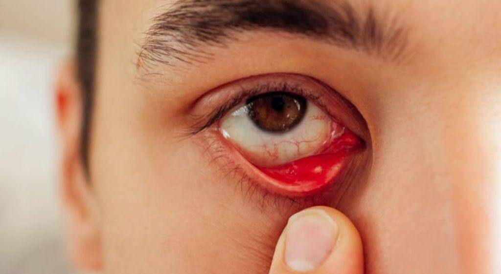 Mí mắt dưới xuất hạt vết chấm màu trắng đục