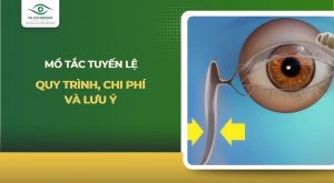mổ tắc tuyến lệ