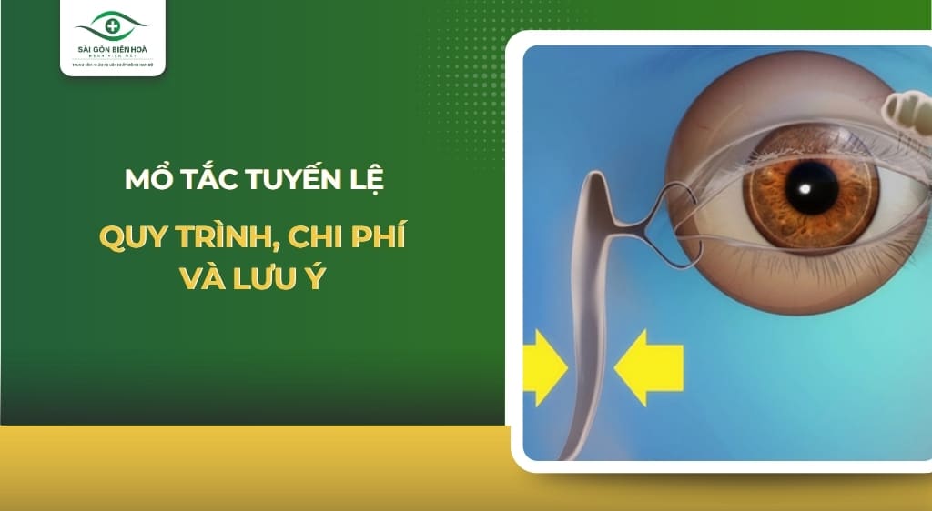 mổ tắc tuyến lệ