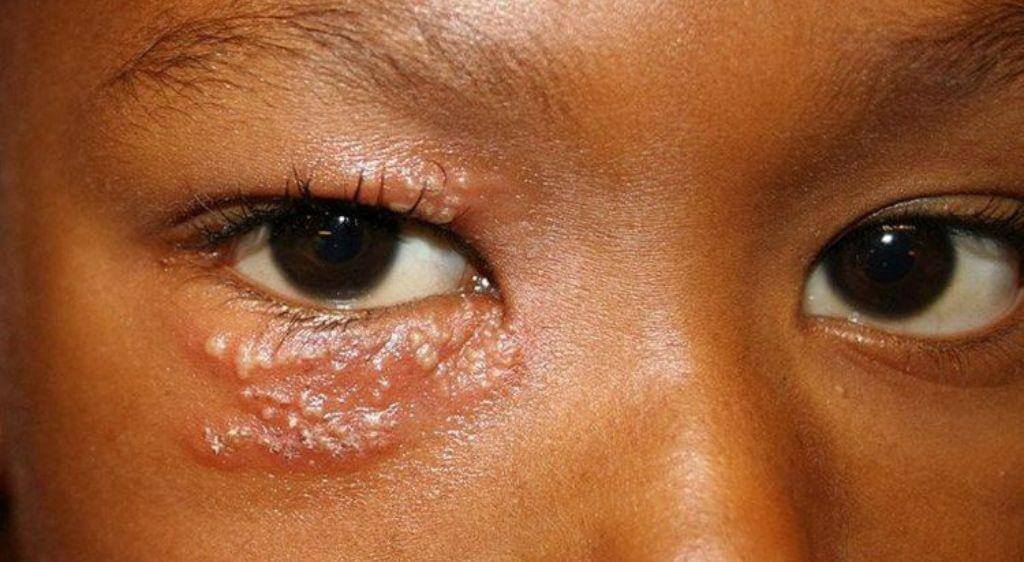 Một số trường hợp zona ở mắt có thể cần thuốc tra mắt theo chỉ định của bác sĩ