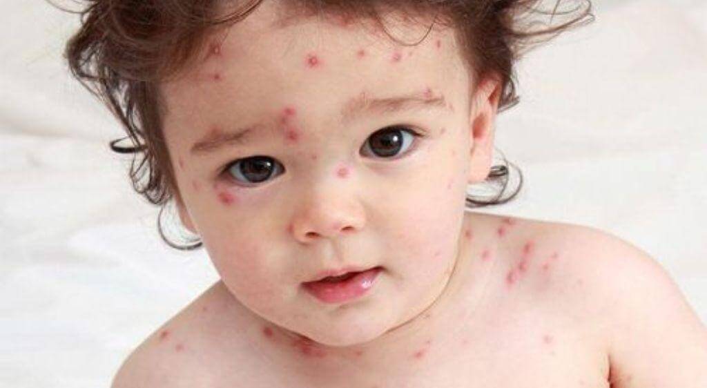 Mụn nước mọc lan khắp mặt là dấu hiệu trẻ bị zona ở mắt đang tiến triển nguy hiểm