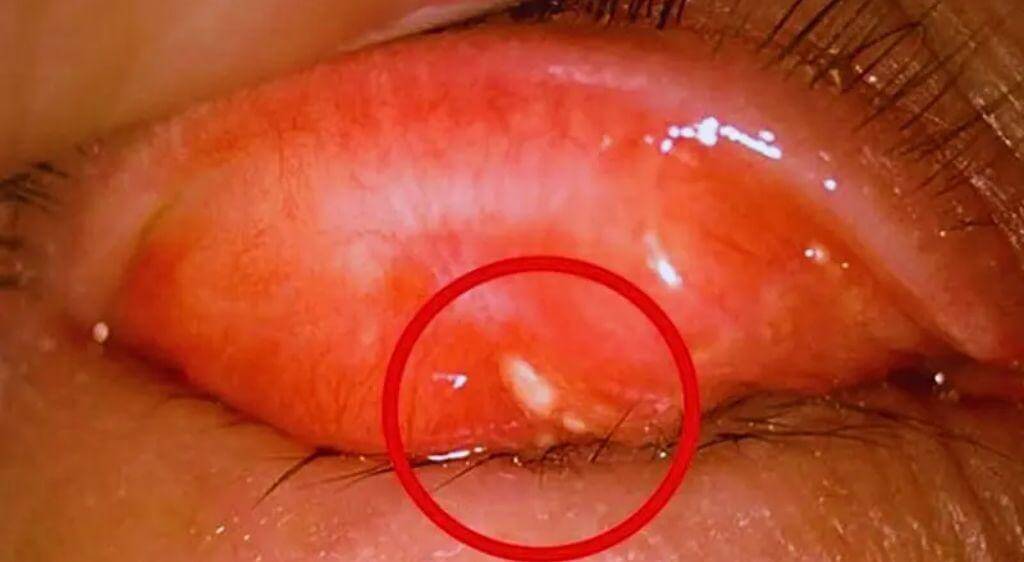 Sạn vôi mắt do tình trạng lắng đọng canxi