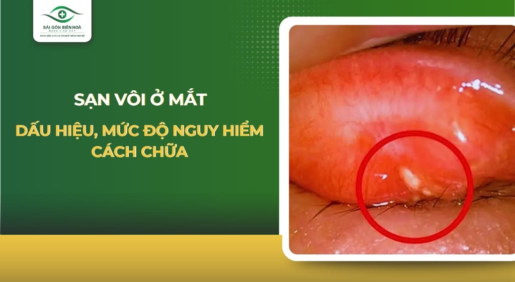 sạn vôi ở mắt