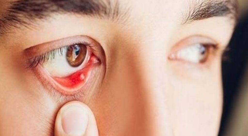 Sỏi mí mắt là bệnh lành tính, nhưng cần điều trị ngay để tránh biến chứng