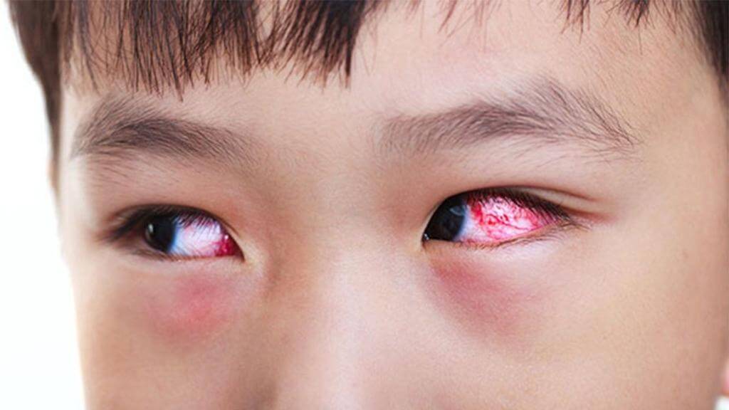 Tắc tuyến lệ kéo dài có thể ảnh hưởng đến giác mạc nếu không được xử lý đúng cách