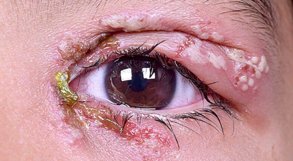 Tình trạng bội nhiễm nguy hiểm cần đưa trẻ đi cấp cứu ngay