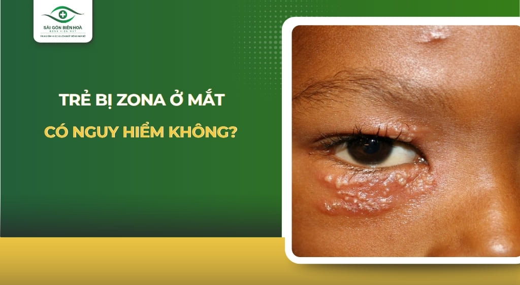 Trẻ bị zona ở mắt