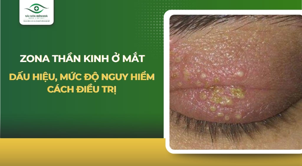 zona thần kinh ở mắt