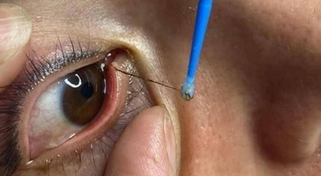 Bắt sâu trong mắt là trào lưu chưa có cơ sở khoa học và tiềm ẩn nhiều nguy cơ đối với sức khỏe mắt