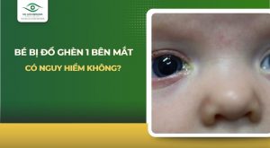 Bé bị đổ ghèn 1 bên mắt
