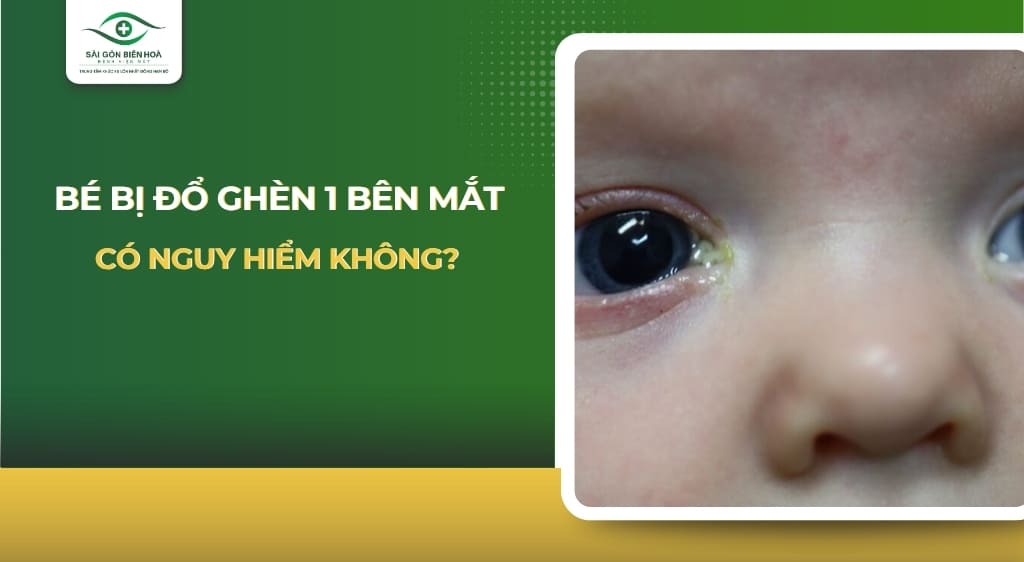 Bé bị đổ ghèn 1 bên mắt