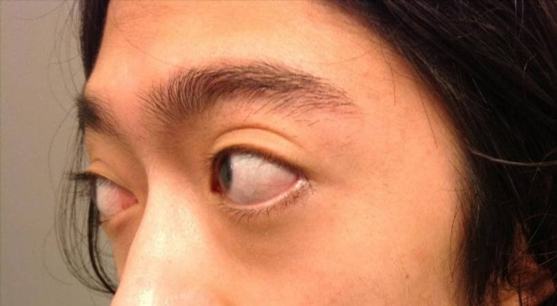 Bệnh Basedow hoàn toàn có thể chữa được nếu được phát hiện sớm