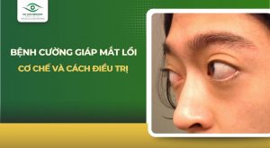 Bệnh cường giáp mắt lồi